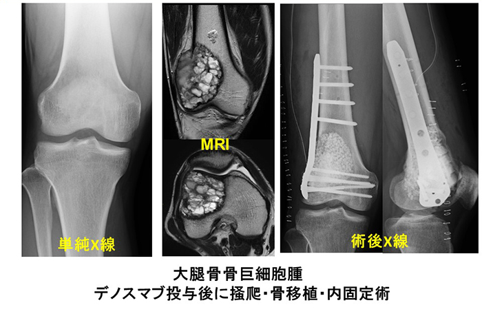 骨・軟部腫瘍グループ