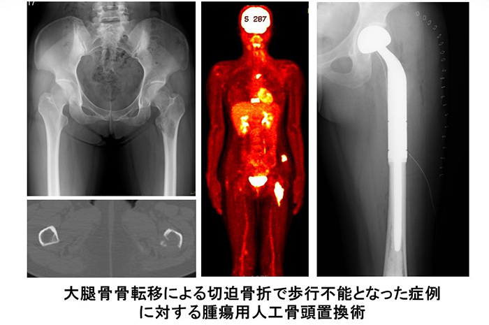 骨・軟部腫瘍グループ