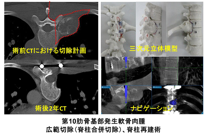 骨・軟部腫瘍グループ